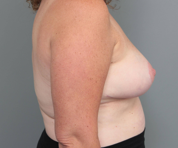 after breast reduction right side view case 1832
