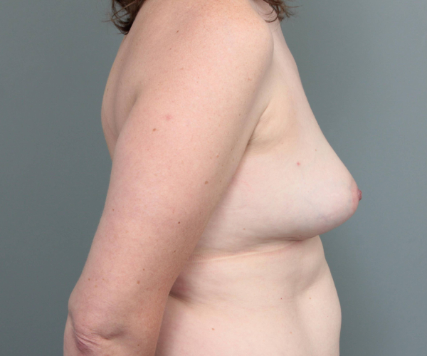 after breast revision right side view case 2355