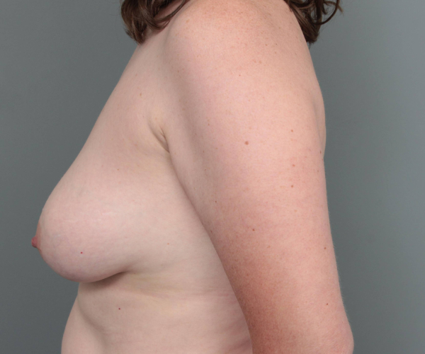 before breast revision left side view case 2355