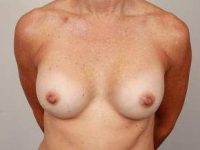 after breast revision front view case 2386