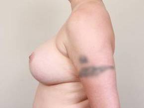 before breast revision left side view case 2393