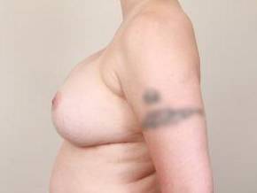 after breast revision left side view case 2393