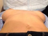 before breast revision lying down view case 2407