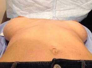 before breast revision lying down view case 2407