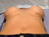 after breast revision lying down view case 2407