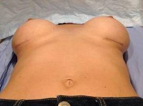after breast revision lying down view case 2407