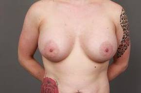 after breast revision front view case 2439