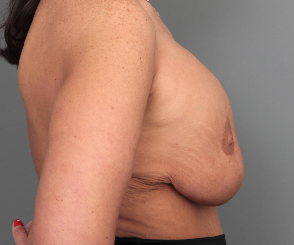 before breast revision right side view case 2454