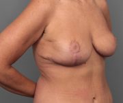 after breast revision right angled view case 2454