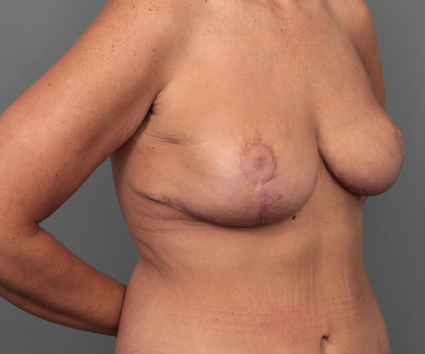 after breast revision right angled view case 2454