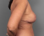 after breast revision right side view case 2454
