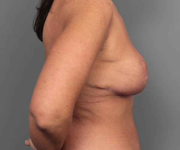 after breast revision right side view case 2454