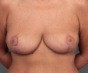 after breast revision front view case 2454