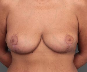 after breast revision front view case 2454