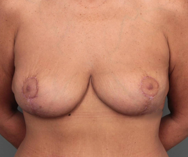 after breast revision front view case 2454