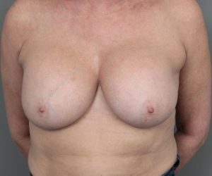 before breast revision front view case 2462