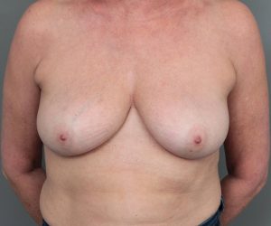after breast revision front view case 2462