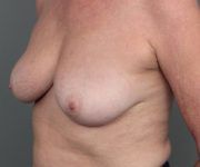 after breast revision left angled view case 2462