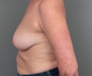 after breast revision left side view case 2462