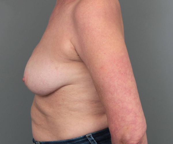 after breast revision left side view case 2462