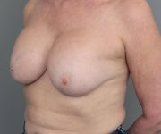 before breast revision left angled view case 2462