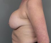 before breast revision left side view case 2462