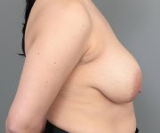 before breast revision right side view case 2486