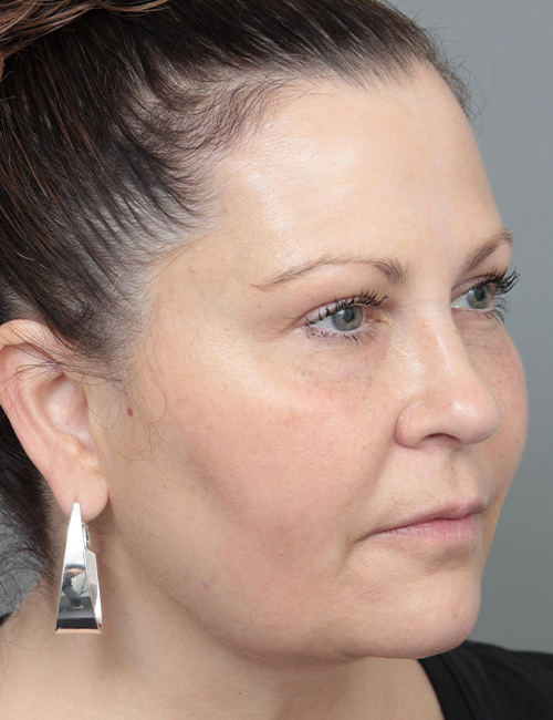 after dermal fillers right angle view female patient case 1327