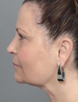 after dermal fillers left side view female patient case 1327