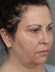 before dermal fillers right angle view female patient case 1327