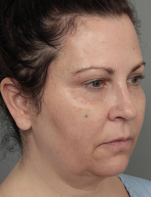 before dermal fillers right angle view female patient case 1327