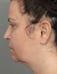 before dermal fillers left side view female patient case 1327