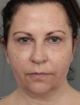 before dermal fillers front view female patient case 1327