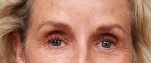 before dermal fillers front close up view female patient case 2987