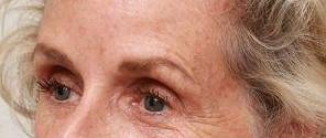 before dermal fillers left angle close up view female patient case 2987