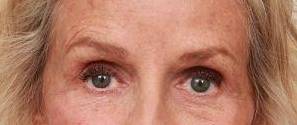 after dermal fillers front close up view female patient case 2987