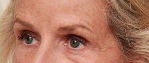 after dermal fillers left angle close up view female patient case 2987