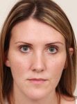 before dermal fillers front view female patient case 2995