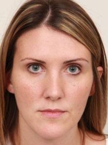 before dermal fillers front view female patient case 2995