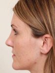 before dermal fillers left side view female patient case 2995