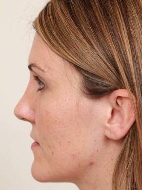 before dermal fillers left side view female patient case 2995