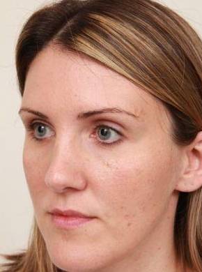 before dermal fillers left angle view female patient case 2995