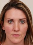 after dermal fillers front view female patient case 2995