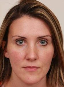 after dermal fillers front view female patient case 2995