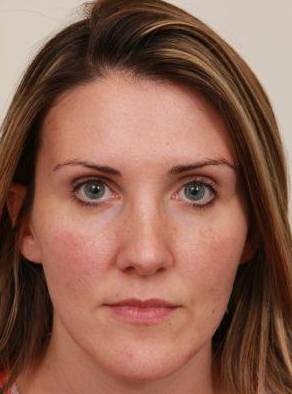 after dermal fillers front view female patient case 2995