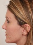 after dermal fillers left side view female patient case 2995