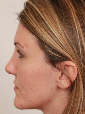 after dermal fillers left side view female patient case 2995