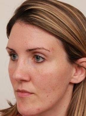 after dermal fillers left angle view female patient case 2995