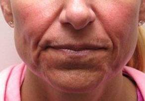 before dermal fillers front close up view female patient case 3008