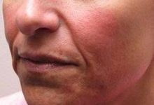 before dermal fillers left angle close up view female patient case 3008